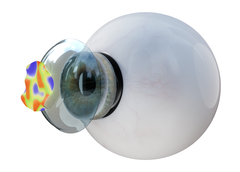 High-Definition Restorative Contact Lenses